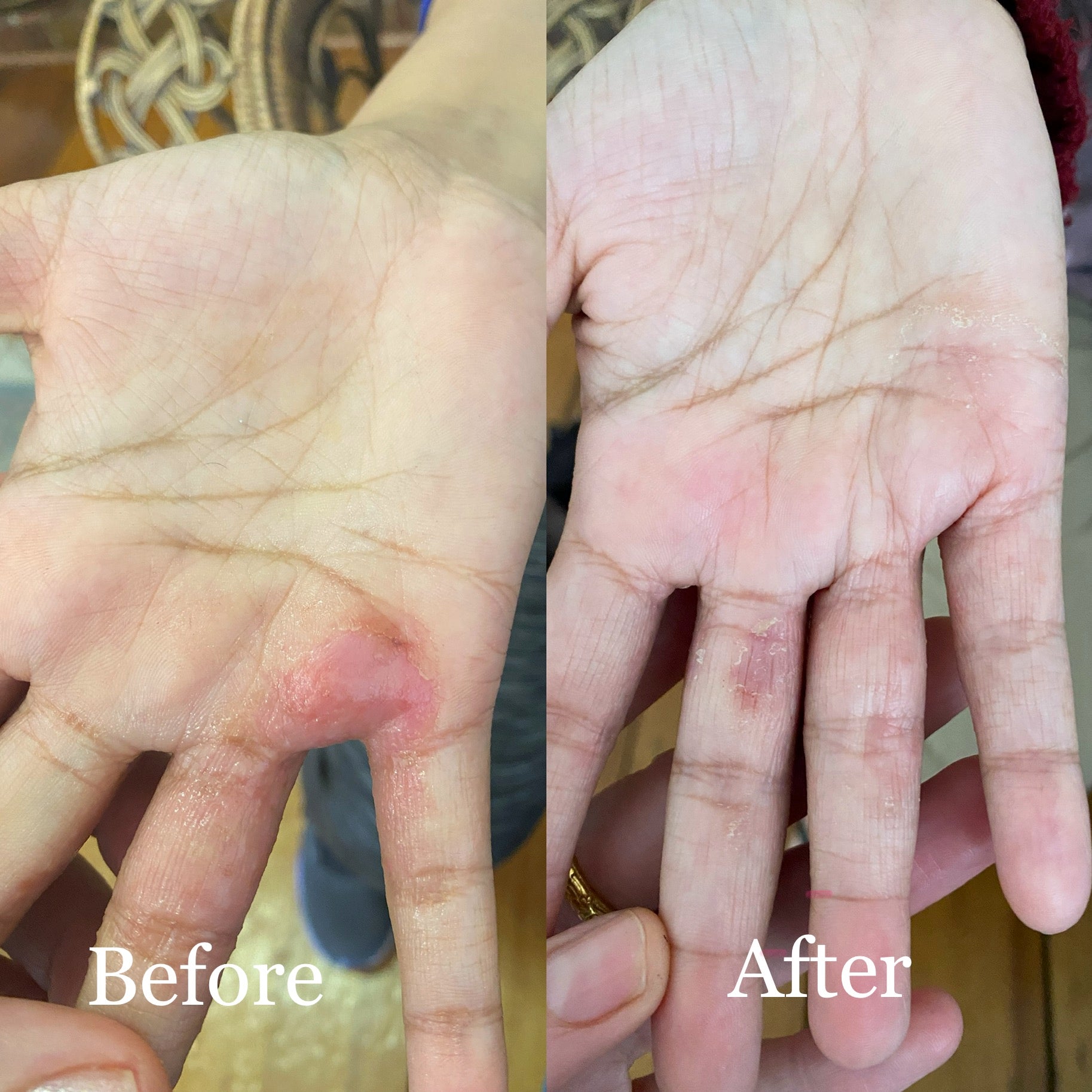 Dermatitis Testimonial