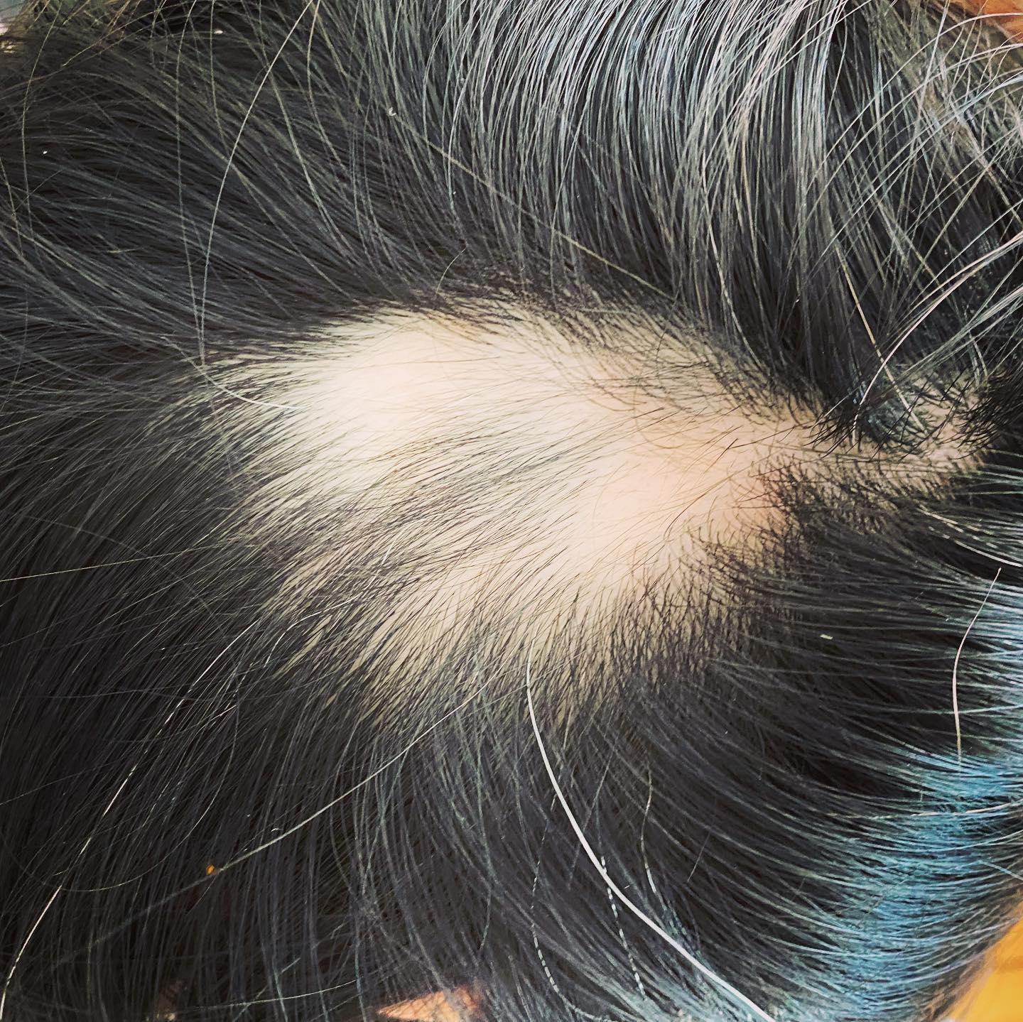 Alopecia - An Ayurvedic perspective