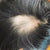 Alopecia - An Ayurvedic perspective