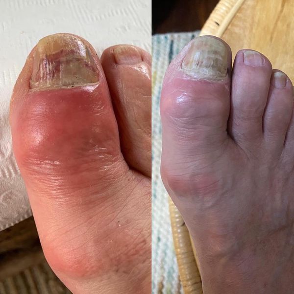 Broken Toe Treatment