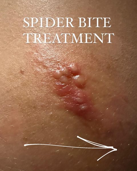 Spider Bite Treatment!