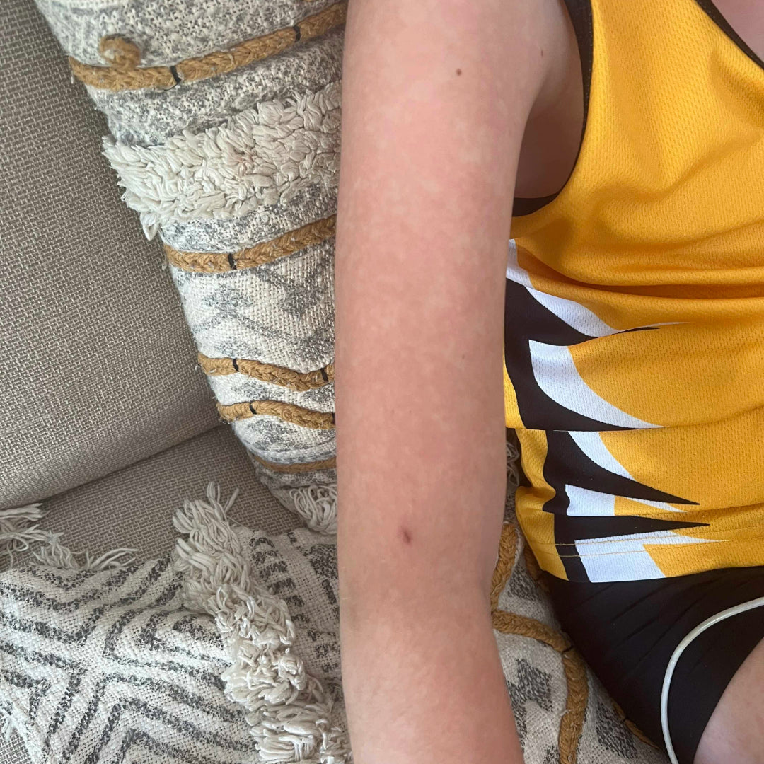 A quick recovery for our 11 year old patient Elva Rose from her urticaria